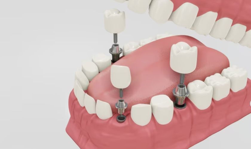 The Ultimate Guide to Finding the Best Dental Implants in Quincy: Tips and Recommendations - Cornerstone Dental Health