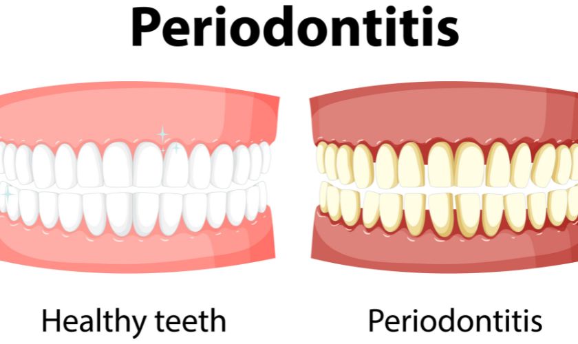 The Ultimate Guide to Finding the Best Dental Implants in Quincy: Tips and Recommendations - Cornerstone Dental Health