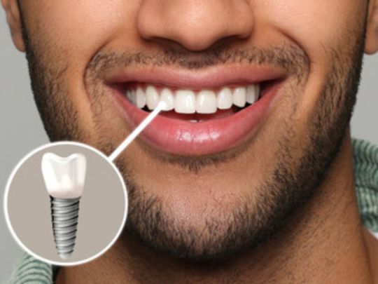 The Ultimate Guide to Finding the Best Dental Implants in Quincy: Tips and Recommendations - Cornerstone Dental Health