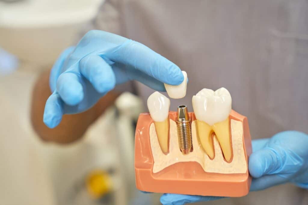 The Ultimate Guide to Finding the Best Dental Implants in Quincy: Tips and Recommendations - Cornerstone Dental Health